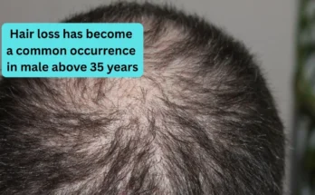 Hair loss has become a common occurrence in male above 35 years