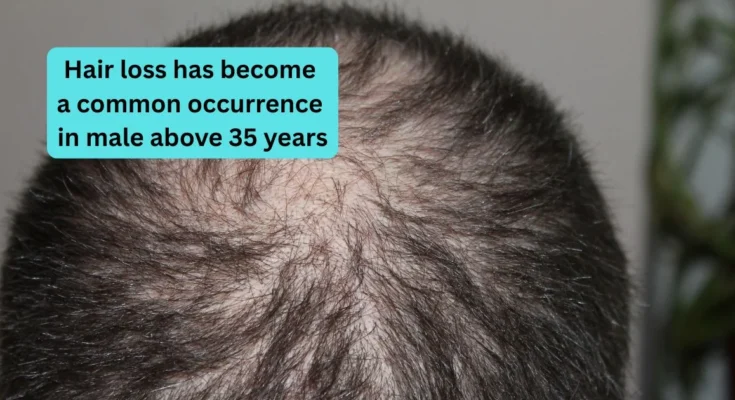 Hair loss has become a common occurrence in male above 35 years